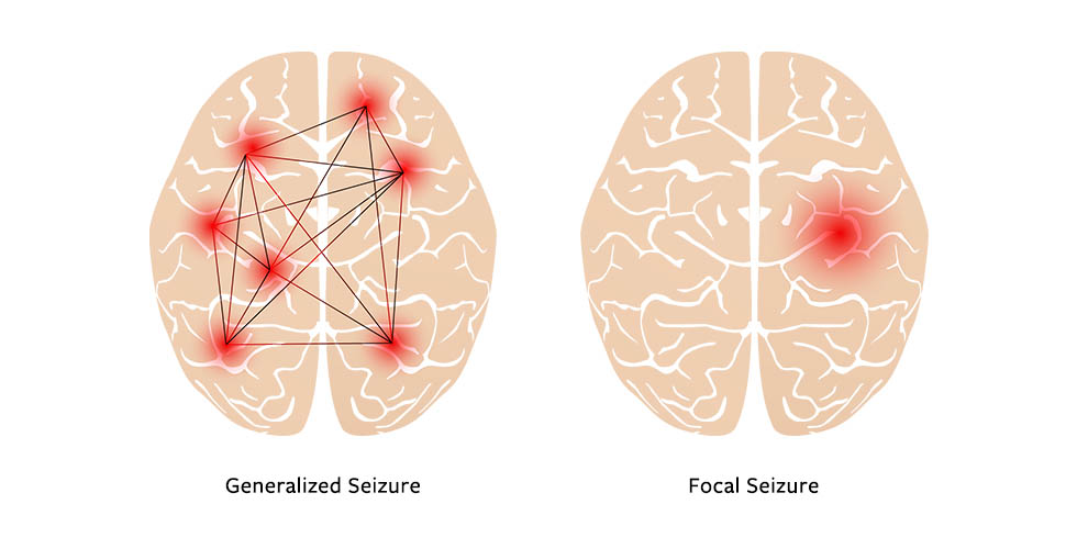 Simple Partial Seizures: Understanding Symptoms, Causes, and Management
