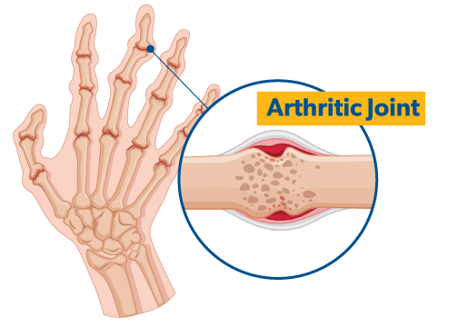 Understanding Arthritis: Causes and Insight